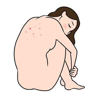 治りにくい背中ニキビ